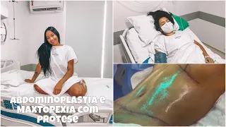 REALIZEI MEU SONHO | FIZ ABDOMINOPLASTIA e MAXTOPEXIA COM PRÓTESE