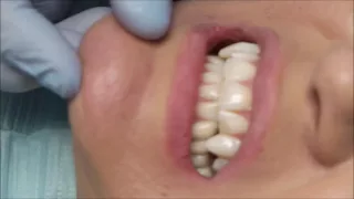 Professionally made Vampire Fangs