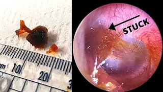 Ultra sticky earwax adhered to the eardrum (extracted with olive oil and suction)