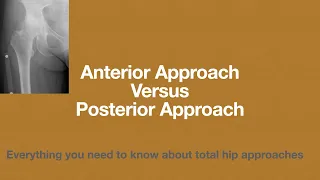 DIRECT ANTERIOR vs POSTERIOR approach to the hip l Total Hip Replacement lon-table vs off-table /DAA