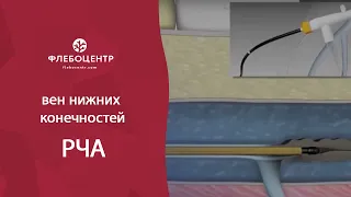 РЧА вен нижних конечностей