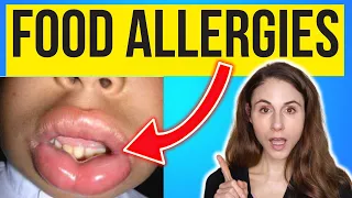 SKIN SIGNS OF FOOD ALLERGIES 😳 Dermatologist @DrDrayzday