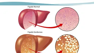 Aula 13  Doenças Hepáticas