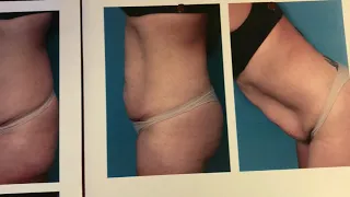 Tummy Tuck Update at 4 Months Post-Op!