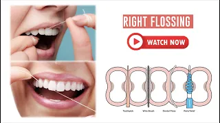 Your Guide to Right Flossing | Types of Flossing Agents | Daily Dental Tips by Dr Chirag Chamria