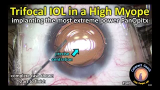 the most extreme Alcon PanOptix IOL power (cataract surgery in a highly myopic patient)