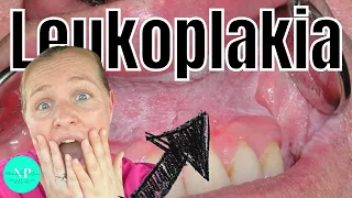 Leukoplakia - Causes, Diagnosis & Treatment (WHAT CAUSES LEUKOPLAKIA)