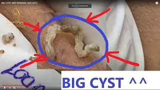 BIG CYST AND REMOVAL SUC (207)