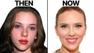 Scarlett Johansson's NEW FACE | Plastic Surgery Analysis