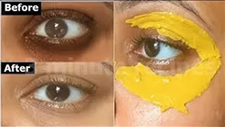 i used Turmeric Eye Mask & Got Rid of DARK CIRCLES in 7 Days Remove Eye Wrinkles & Under Eye Bags