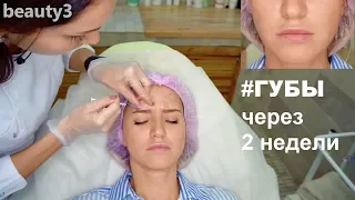 Инъекции ботокс +  результат увеличения губ (через 2 недели)