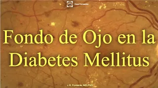 Clase de Fondo de Ojo en la Diabetes Mellitus. Retinopatía Diabética.