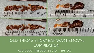 OLD, THICK & STICKY EAR WAX REMOVAL COMPILATION - EP 207