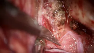 Pterional Craniotomy for Resection of a Tuberculum Sella Meningioma