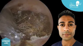 1,251 - Deep Plug Ear Wax Removal