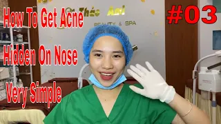 Enjoy Your Day with THAO AMI SPA - Get A Very Simple Hidden Pimple On The Nose