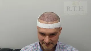 Пересадка волос в Real Trans Hair. Реальный опыт трансплантации пациентов RTH