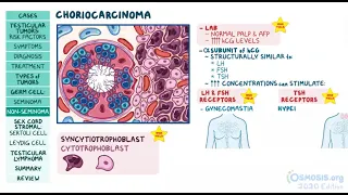 Testicular Tumors | Osmosis