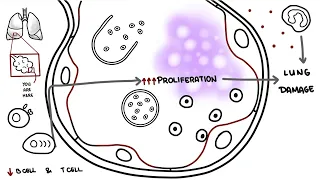 Pneumocystis jirovecii - Pneumocystis pneumonia