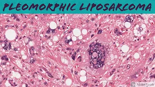 Pleomorphic Liposarcoma: 5-Minute Pathology Pearls