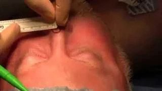 Excision Basal Cell Carcinoma of the Nose and Bilobe Flap Reconstruction - New Jersey