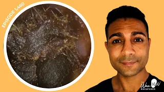 1,460 - Cerumenectomy of Impacted Dark & Dense Ear Wax using Rai Curette & Microsuction