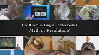 Dr. Rafi Romano - CADCAM in Lingual Orthodontics - Myth or Revolution?