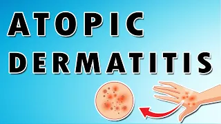 Atopic Dermatitis and Eczema Symptoms, Treatment, and Causes