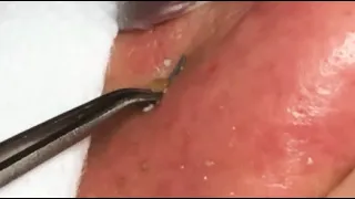 GREAT JOB!! BLACKHEADS REMOVAL ON NOSE