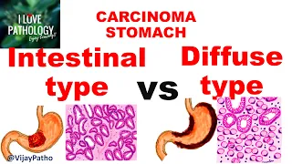 Carcinoma Stomach: INTESTINAL VS DIFFUSE GASTRIC CANCER
