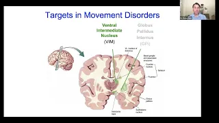 Focused Ultrasound for Parkinsons Disease & Essential Tremor