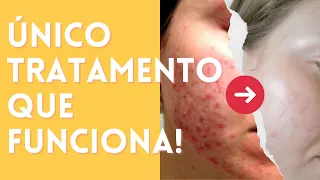 Quais Produtos Usar para ELIMINAR A ACNE FÚNGICA? | Rotina passo a passo para limpar sua pele ✨