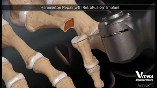 hammertoe repair with retro fusion .implant