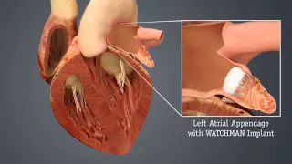 HCA Virginia – WATCHMAN Video 2: Left Atrial Appendage Closure Device