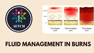 Fluid Management in Burns