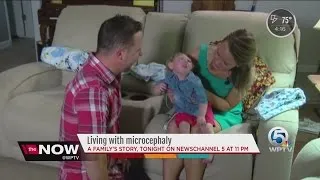 Living with microcephaly