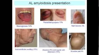 II Simposio Internacional de Amiloidosis - 11/09/2014 (4ª Parte)