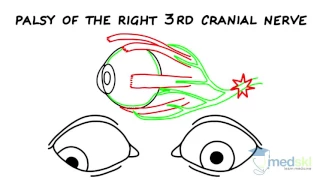 Ophthalmology – Strabismus: By Yi Ning Strube M.D.