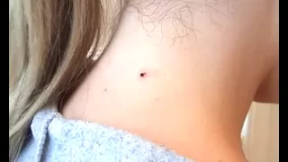 Skin Tag Removal in 15 Mins @ Home!