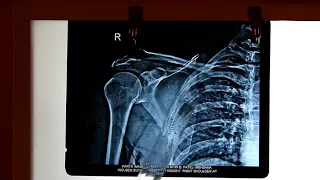 Radiological Anatomy of Upper limb