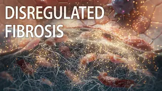 Anti-CTGF therapy  | idiopathic pulmonary fibrosis animation | myocardial fibrosis | fibroblasts