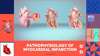 Pathophysiology of #Myocardial #Infarction ( #MI )