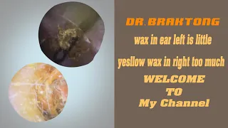 Crinkled Dead Skin Peeled Off Ear Canal I Wax in ear left is little,