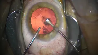 First global (post CE mark) implantation of RayOne Hydrophobic RAO800C