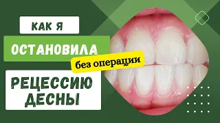 Как я остановила рецессию десны без операции. 4 минуты в день, и десны стали возвращаться на место