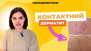 Контактний дерматит. Софія дерматолог.