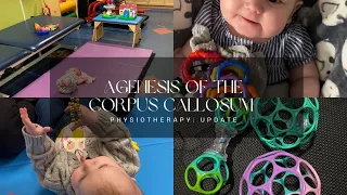 Agenesis of the Corpus Callosum |  Physiotherapy Update