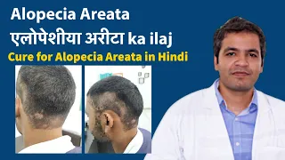 Alopecia Areata के कारण, लक्षण और घरेलू उपाय – Alopecia areata treatment in Hindi | गंजेपन का इलाज