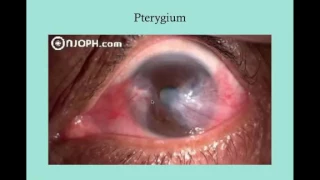 Other Conjunctival Disorders   CRASH! USMLE Step 2 and 3