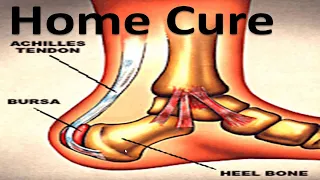 Heel Bursitis & Achilles Tendon Bursitis [Best HOME Treatment!]